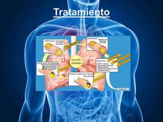 Tratamiento
 