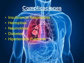 Complicaciones
• Insuficiencia Respiratoria
• Hemoptisis
• Neumotórax
• Diabetes
• Hipertensión Pulmonar
 