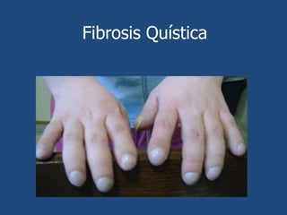 Fibrosis QuísticaEnfermedad endocrina y crecimiento:Puede ser producto de daño en el páncreas provoca perdida de células islotes y conducir a la diabetes.Las personas con FQ frecuente presenta en mano y pies, una malformación en forma de palillo de tambor.La prueba de función pulmonar miden la capacidad de los pulmones,  volúmenes y rapidez de flujo aéreos.