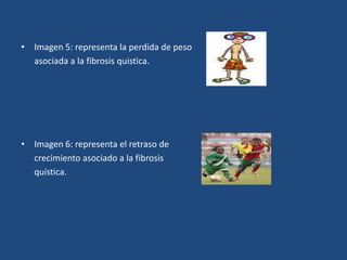 Imagen 5: representa la perdida de peso      asociada a la fibrosis quistica.Imagen 6: representa el retraso de     crecimiento asociado a la fibrosis     quística. 