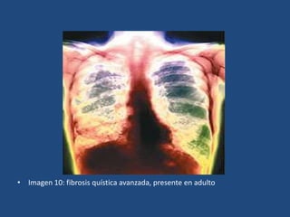 Imagen 10: fibrosis quística avanzada, presente en adulto
