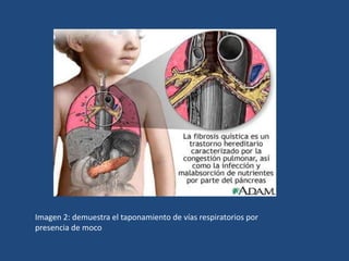 Imagen 2: demuestra el taponamiento de vías respiratorios por presencia de moco