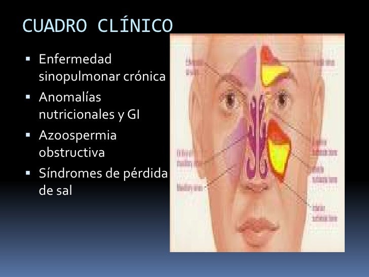 Fibrosis quística Fibrosis quística