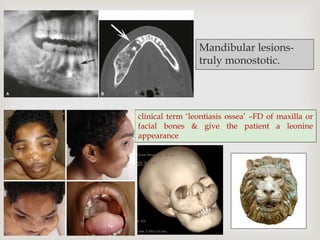 
Mandibular lesions-
truly monostotic.
clinical term ‘leontiasis ossea’ –FD of maxilla or
facial bones & give the patient a leonine
appearance
 