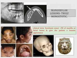 Fibrous Dysplasia pptx