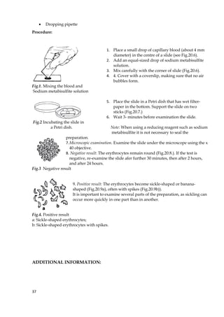 • Dropping pipette
Procedure:
1. Place a small drop of capillary blood (about 4 mm
diameter) in the centre of a slide (see Fig.20.6).
2. Add an equal-sized drop of sodium metabisulfite
solution.
3. Mix carefully with the corner of slide (Fig.20.6).
4. 4. Cover with a coverslip, making sure that no air
bubbles form.
Fig.1. Mixing the blood and
Sodium metabisulfite solution
5. Place the slide in a Petri dish that has wet filter-
paper in the bottom. Support the slide on two
sticks (Fig.20.7.)
6. Wait 3- minutes before examination the slide.
Fig.2 Incubating the slide in
a Petri dish. Note: When using a reducing reagent such as sodium
metabisulfite it is not necessary to seal the
preparation.
7.Microscopic examination. Examine the slide under the microscope using the x
40 objective.
8. Negative result: The erythrocytes remain round (Fig.20.8.). If the test is
negative, re-examine the slide afer further 30 minutes, then after 2 hours,
and after 24 hours.
Fig.3 Negative result
9. Positive result: The erythrocytes become sickle-shaped or banana-
shaped (Fig.20.9a), often with spikes (Fig.20.9b)).
It is important to examine several parts of the preparation, as sickling can
occur more quickly in one part than in another.
Fig.4. Positive result
a: Sickle-shaped erythrocytes;
b: Sickle-shaped erythrocytes with spikes.
ADDITIONAL INFORMATION:
37
 