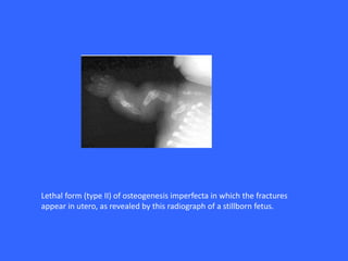 Lethal form (type II) of osteogenesis imperfecta in which the fractures
appear in utero, as revealed by this radiograph of a stillborn fetus.
 