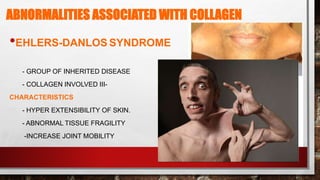 ABNORMALITIES ASSOCIATED WITH COLLAGEN
•EHLERS-DANLOS SYNDROME
- GROUP OF INHERITED DISEASE
- COLLAGEN INVOLVED III-
CHARACTERISTICS
- HYPER EXTENSIBILITY OF SKIN.
- ABNORMAL TISSUE FRAGILITY
-INCREASE JOINT MOBILITY
31
 