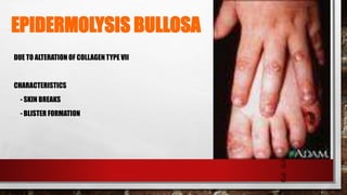 EPIDERMOLYSIS BULLOSA
DUE TO ALTERATION OF COLLAGEN TYPE VII
CHARACTERISTICS
- SKIN BREAKS
- BLISTER FORMATION
3
3
 