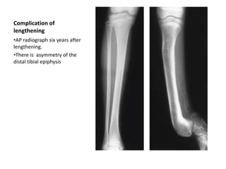 Fibular deficiency and management.pptx