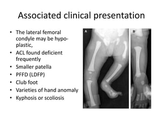 Fibular deficiency and management.pptx
