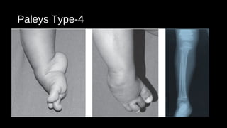 Fibular hemimelia | PPT