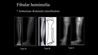 Fibular hemimelia | PPT