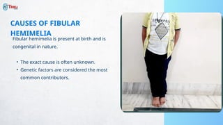 Fibular hemimelia - Trishla Orthopaedic | PPTX