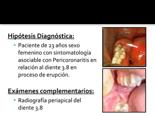 Hipótesis Diagnóstica: Paciente de 23 años sexo femenino con sintomatología asociable con Pericoronaritis en relación al diente 3.8 en proceso de erupción. Exámenes complementarios: Radiografía periapical del diente 3.8 