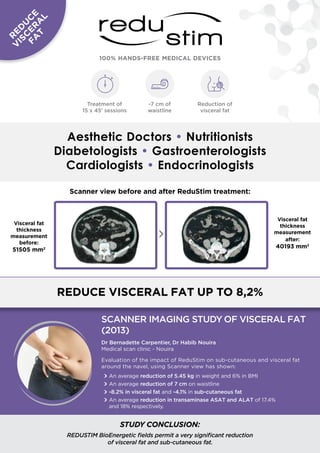 100% HANDS-FREE MEDICAL DEVICES
Aesthetic Doctors • Nutritionists
Diabetologists • Gastroenterologists
Cardiologists • Endocrinologists
reduce visceral fat up to 8,2%
Scanner view before and after ReduStim treatment:
SCANNER IMAGING STUDY OF VISCERAL FAT
(2013)
Dr Bernadette Carpentier, Dr Habib Nouira
Medical scan clinic - Nouira
Evaluation of the impact of ReduStim on sub-cutaneous and visceral fat
around the navel, using Scanner view has shown:
WWAn average reduction of 5.45 kg in weight and 6% in BMI
WWAn average reduction of 7 cm on waistline
WW-8.2% in visceral fat and -4.1% in sub-cutaneous fat
WWAn average reduction in transaminase ASAT and ALAT of 17.4%
and 18% respectively.
Treatment of
15 x 45’ sessions
STUDY CONCLUSION:
REDUSTIM BioEnergetic fields permit a very significant reduction
of visceral fat and sub-cutaneous fat.
R
ED
U
C
E
V
ISC
ER
A
L
FA
T
Visceral fat
thickness
measurement
before:
51505 mm2
Visceral fat
thickness
measurement
after:
40193 mm2
Reduction of
visceral fat
-7 cm of
waistline
 