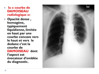  la « courbe de
DAMOISEAU
radiologique »:
 Opacité dense ,
homogène,
typiquement
liquidienne, limitée
en haut par une
courbe concave vers
le haut et vers le
dedans: c’est la
courbe de
DAMOISEAU dont
l’aspect est
évocateur d’emblée
du diagnostic.
 