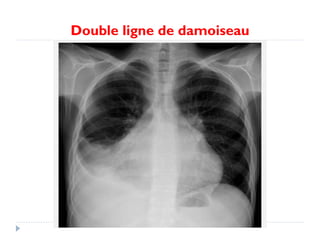 Double ligne de damoiseau
 