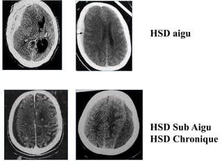 HSD aigu
HSD Sub Aigu
HSD Chronique
 