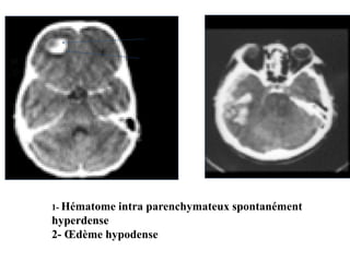 1- Hématome intra parenchymateux spontanément
hyperdense
2- Œdème hypodense
1
2
 