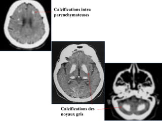 Calcifications intra
parenchymateuses
Calcifications des
noyaux gris
 