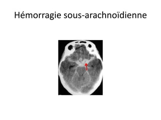 Hémorragie sous-arachnoïdienne
 