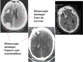 Hémorragie
méningée
Espaces sous
arachnoïdiens
Hémorragie
méningée
Faux du
cerveau
 