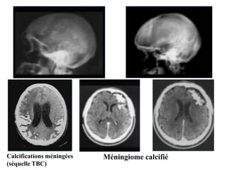 Calcifications méningées
(séquelle TBC)
Méningiome calcifié
 