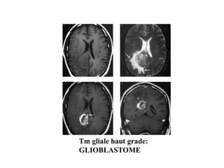 Tm gliale haut grade:
GLIOBLASTOME
 