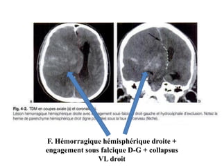 F. Hémorragique hémisphérique droite +
engagement sous falcique D-G + collapsus
VL droit
 