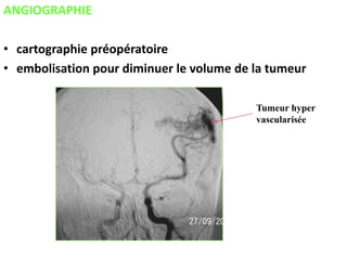 ANGIOGRAPHIE
• cartographie préopératoire
• embolisation pour diminuer le volume de la tumeur
Tumeur hyper
vascularisée
 