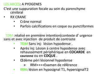 LES ABCES: A PYOGENES
C’est une suppuration focale au sein du parenchyme
cérébral
• RX CRANE
• Crâne normal
• Parfois calcifications en coque ou punctiformes
TDM :réalisé en première intention(contexte d’ urgence
sans et avec injection de produit de contraste
• TDM Sans inj: lésion hypodense .
• Après inj: Lésion à centre hypodense avec
rehaussement périphérique en COCARDE en
couronne ou en COQUE .
• Œdème péri lésionnel hypodense
» IRM++++Examen de référence
• IRM: lésion en hyposignal T1, hypersignalT2
 