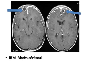 • IRM Abcès cérébral
 