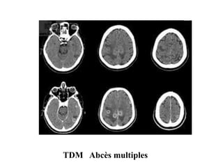 TDM Abcès multiples
 