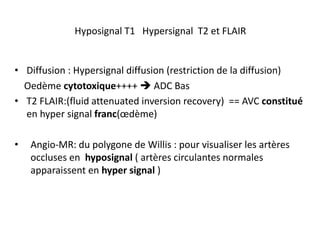 Hyposignal T1 Hypersignal T2 et FLAIR
• Diffusion : Hypersignal diffusion (restriction de la diffusion)
Oedème cytotoxique++++  ADC Bas
• T2 FLAIR:(fluid attenuated inversion recovery) == AVC constitué
en hyper signal franc(œdème)
• Angio-MR: du polygone de Willis : pour visualiser les artères
occluses en hyposignal ( artères circulantes normales
apparaissent en hyper signal )
 