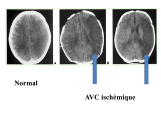 Normal
AVC ischémique
 