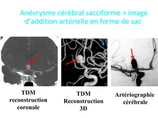 Anévrysme cérébral sacciforme = image
d’addition artérielle en forme de sac
TDM
reconstruction
coronale
TDM
Reconstruction
3D
Artériographie
cérébrale
 