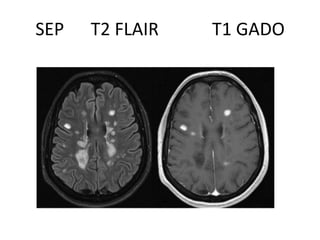 SEP T2 FLAIR T1 GADO
 