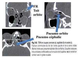 FR
Toit
orbite
Pneumo orbite
Pneumo céphalie
 