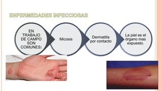 La piel es el
órgano mas
expuesto.
Dermatitis
por contacto
Micosis
EN
TRABAJO
DE CAMPO
SON
COMUNES:
 