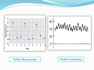 Fiebre Recurrente Fiebre Continua 
 