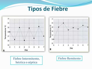 Tipos de Fiebre 
Fiebre Intermitente, 
héctica o séptica 
Fiebre Remitente 
 