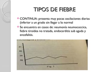TIPOS DE FIEBRETIPOS DE FIEBRE
 CONTINUA: presenta muy pocas oscilaciones diarias
(inferior a un grado sin llegar a lo normal
 Se encuentra en casos de: neumonía neumococcica,
fiebre tiroidea no tratada, endocarditis sub aguda y
encefalitis.
 