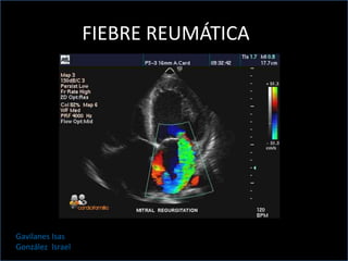 FIEBRE REMATICA
FIEBRE REUMÁTICA
Gavilanes Isas
González Israel
 