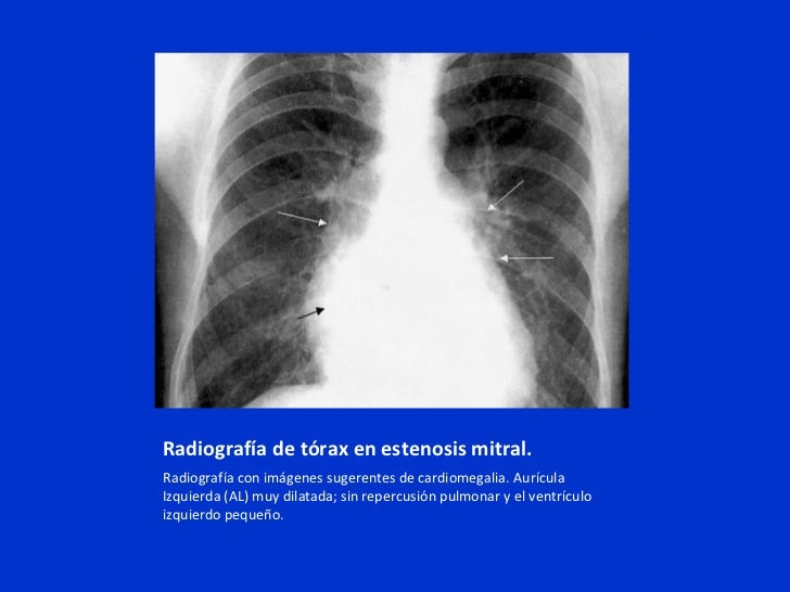 causas de hipertensión portal hombre