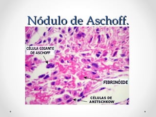 Nódulo de Aschoff.Nódulo de Aschoff.
 