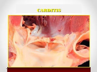 CARDITISCARDITIS
 