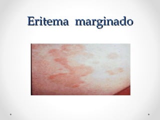 Eritema marginadoEritema marginado
 