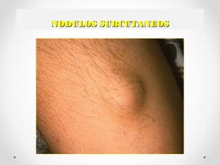 NODULOS SUBCUTANEOSNODULOS SUBCUTANEOS
 