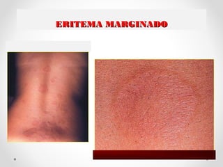 ERITEMA MARGINADOERITEMA MARGINADO
 